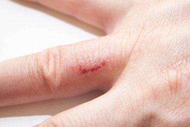 El dermatiti. El egzaması beyaz arka planda kapalı. Deri iltihabı cilt iltihabıdır.