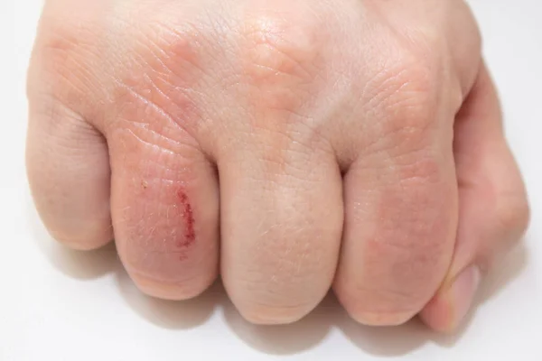 El dermatiti. El egzaması beyaz arka planda kapalı. Deri iltihabı cilt iltihabıdır.