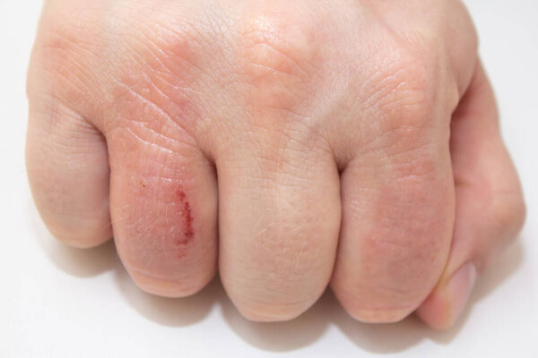 Hand dermatitis. Hand eczema closed on white background. Dermatitis is an inflammation of the skin