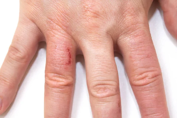 Hand Dermatitis Hand Eczeem Gesloten Witte Achtergrond Dermatitis Een Ontsteking — Stockfoto