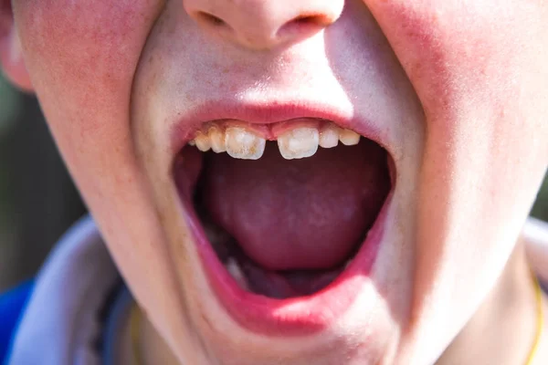 Toddler with mouth opened wide to show lower baby teeth at dental check-up, Close-up portrait of a screaming boy Little boy show Broken teeth.boy with a broken and rotten teeth