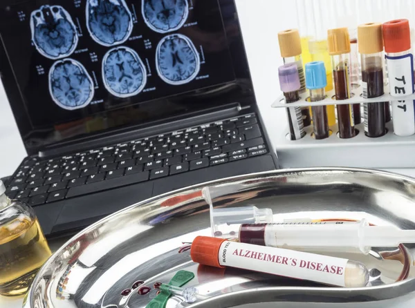 Amostra Sangue Para Investigar Remédio Contra Doença Alzheimer Imagem Conceitual — Fotografia de Stock