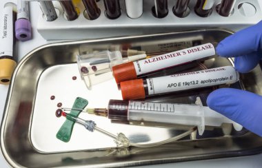 Bilim adamı Alzheimer hastalığı, kavramsal görüntü karşı ilaç araştırmak için kan örneği tutar