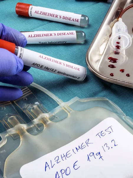 科学者は概念図アルツハイマー病に対する治療薬を調査するための血液サンプルを保持します — ストック写真