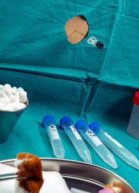 Oxford kovid-19 aşısı enjekte edildikten sonra transvers miyelit hastalarda serebrospinal sıvıyı çıkarmak için anestezi ve antibiyotikle birlikte lumbar ponksiyon iğnesi.