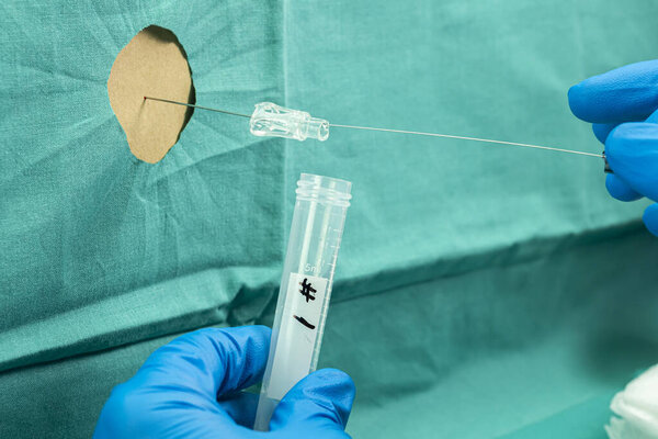 Person affected with Transverse Myelitis after being injected by Oxford Covid-19 experimental vaccine, physician extracts cerebrospinal fluid to investigate causes, conceptual image