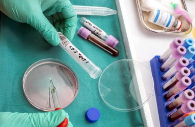 Scientific with petri-disk sampling of cerebrospinal fluid in patients with transverse myelitis after being injected with an experimental Oxford covid-19 vaccine, conceptual image clipart