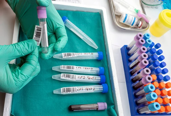 Scientific sticker on blood sample vial with four samples of cerebrospinal fluid in patients with transverse myelitis after being injected with an experimental Oxford covid-19 vaccine, conceptual image