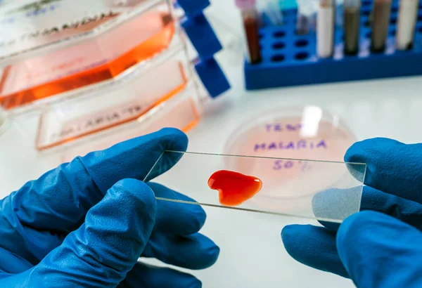 Vědec Zkoumá Krevní Vzorek Nemocné Osoby Malárií Laboratoři Koncepční Obraz — Stock fotografie
