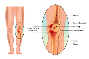 bone edema of knee medical poster clipart