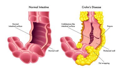 Crohns hastalığı tıbbi poster