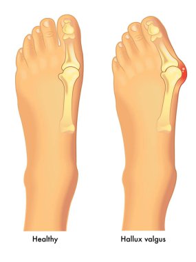 hallux valgus tıbbi poster