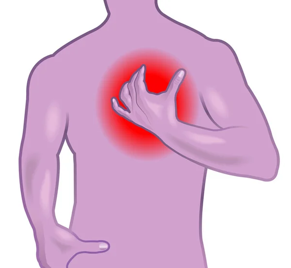 Infarkt Příznaky Lékařské Plakát — Stockový vektor