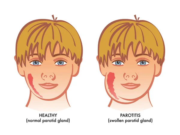 Parotitis Medizinisches Poster Auf Weißem Hintergrund — Stockvektor