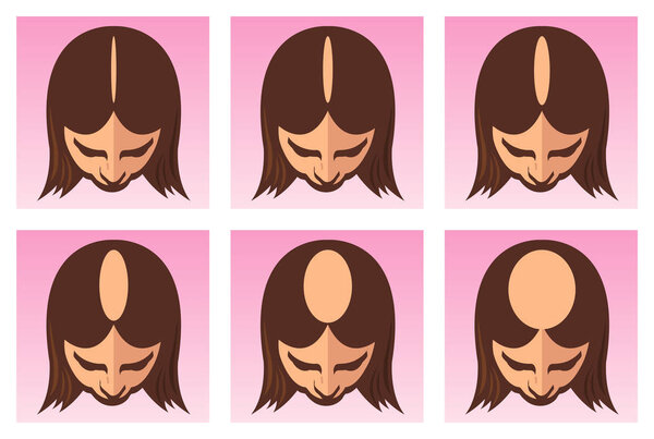 stages of female alopecia poster