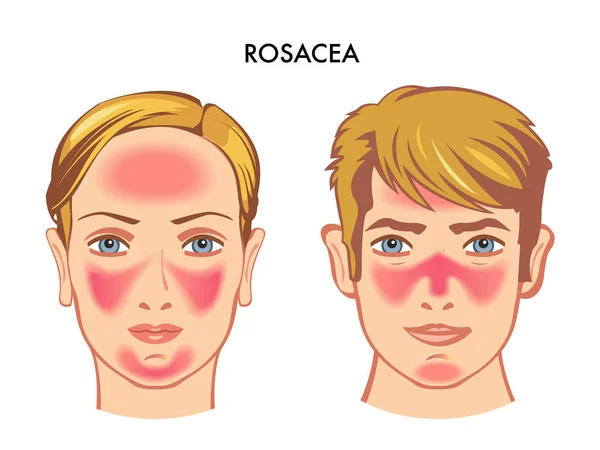 Rosazea Medizinisches Poster Auf Weißem Hintergrund — Stockvektor