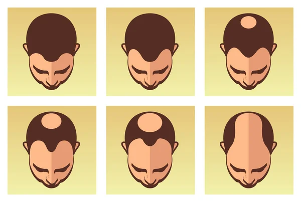 Stages Male Alopecia Poster — Stock Vector