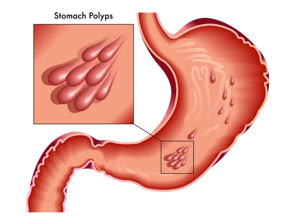 Maag Poliepen Poster Witte Achtergrond — Stockvector