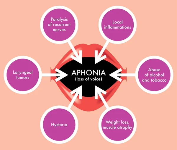 สาเหต ของภาพเวกเตอร Aphonia — ภาพเวกเตอร์สต็อก