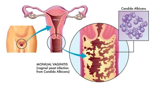 Monilial Vaginitis Vectorillustratie — Stockvector