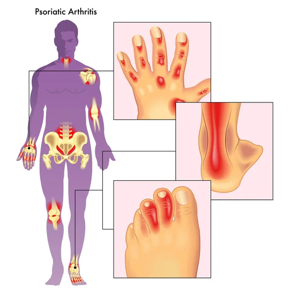 Ilustración Vectorial Artritis Psoriásica — Vector de stock