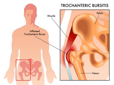 Beyaz arka planda trochanteric bursitis vektör illüstrasyon