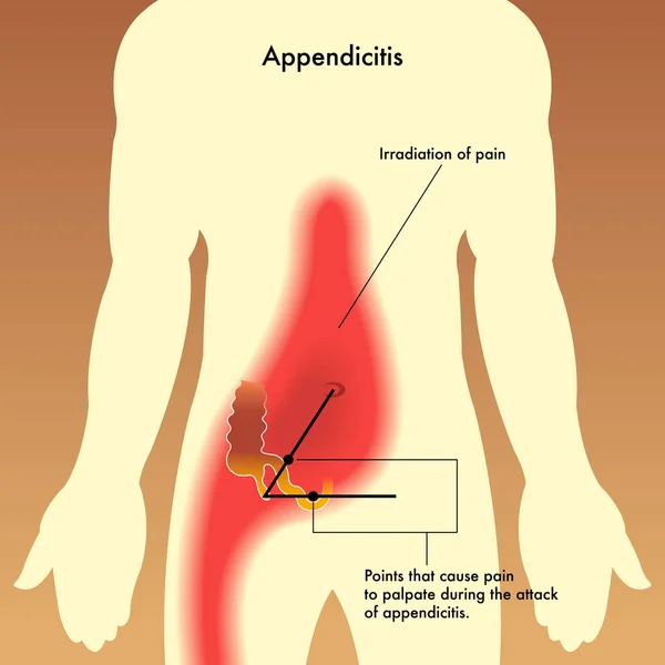 Apendicitis Dolor Vector Ilustración — Vector de stock