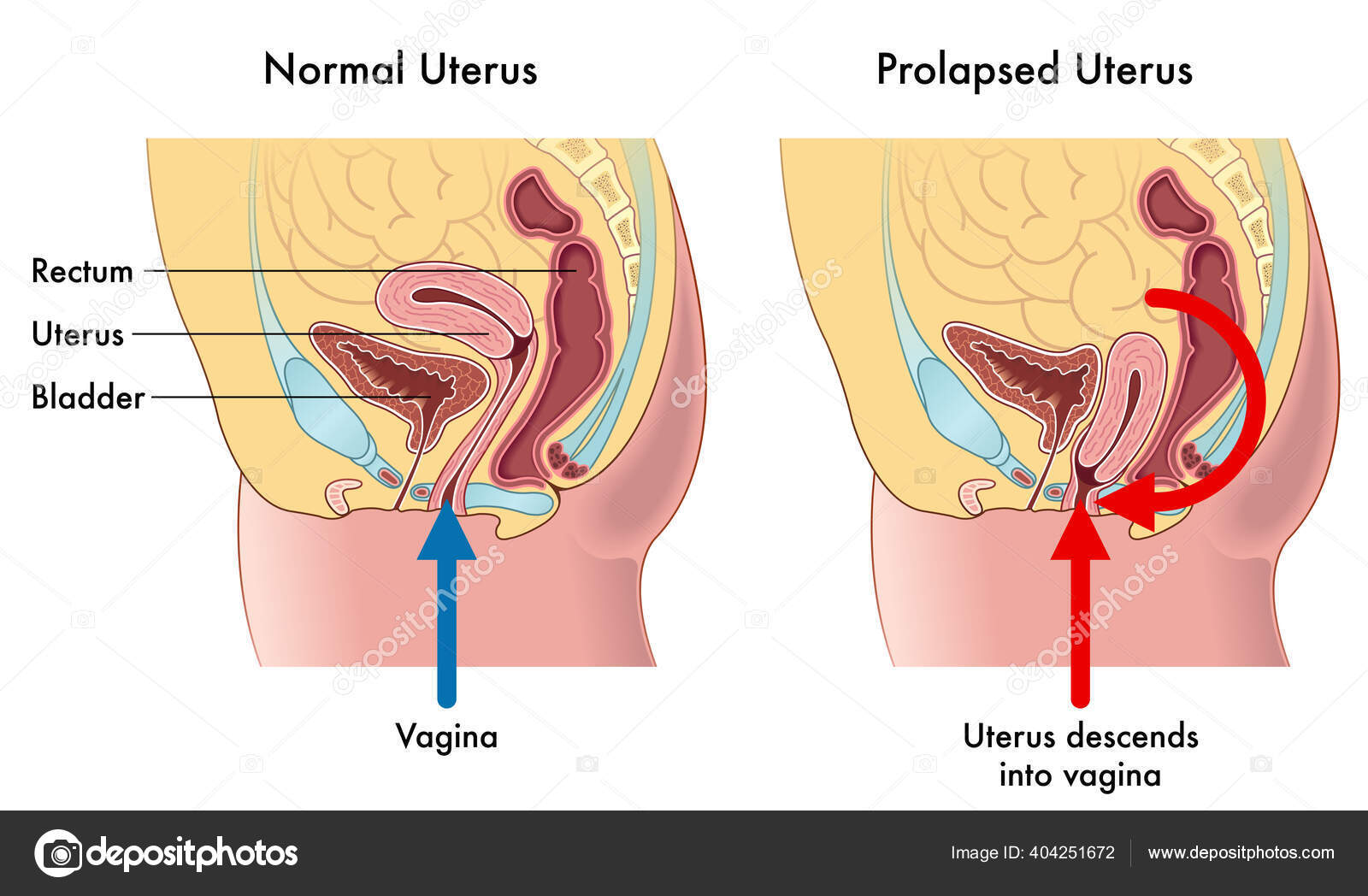Medical Illustration Showing Difference Normal Uterus Prolapsed