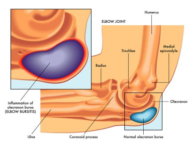 Medical illustration of elbow bursitis symptoms with annotations. clipart