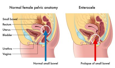 Tıbbi örneklere göre kadın pelvik anatomisi normal ince bağırsağı olan Enterocele adlı ince bağırsağın sarkmasıyla karşılaştırıldığında normal..