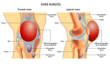 Önden ve yandan görülen iltihaplı bursa (BURSITIS) sahip bir dizin tıbbi çizimi.