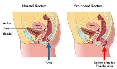 Medical illustration showing the difference between a normal rectum and a prolapsed rectum, with annotations explaining how this occurs. clipart