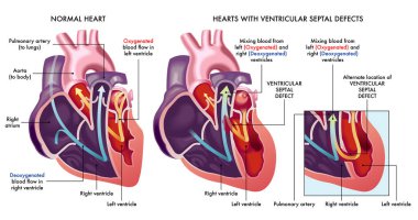 Medical illustration that compares a normal heart with hearts afflicted by ventricular septal defects, an abnormal opening (hole) in the heart, with annotations. clipart