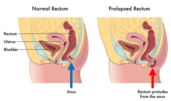医学说明显示正常直肠和脱垂直肠之间的区别 并附有说明 解释这种情况是如何发生的 — 图库矢量图片