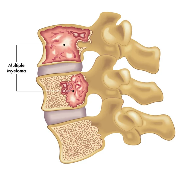 Ilustración Médica Dos Vértebras Columna Vertebral Afectadas Por Mieloma Múltiple — Archivo Imágenes Vectoriales