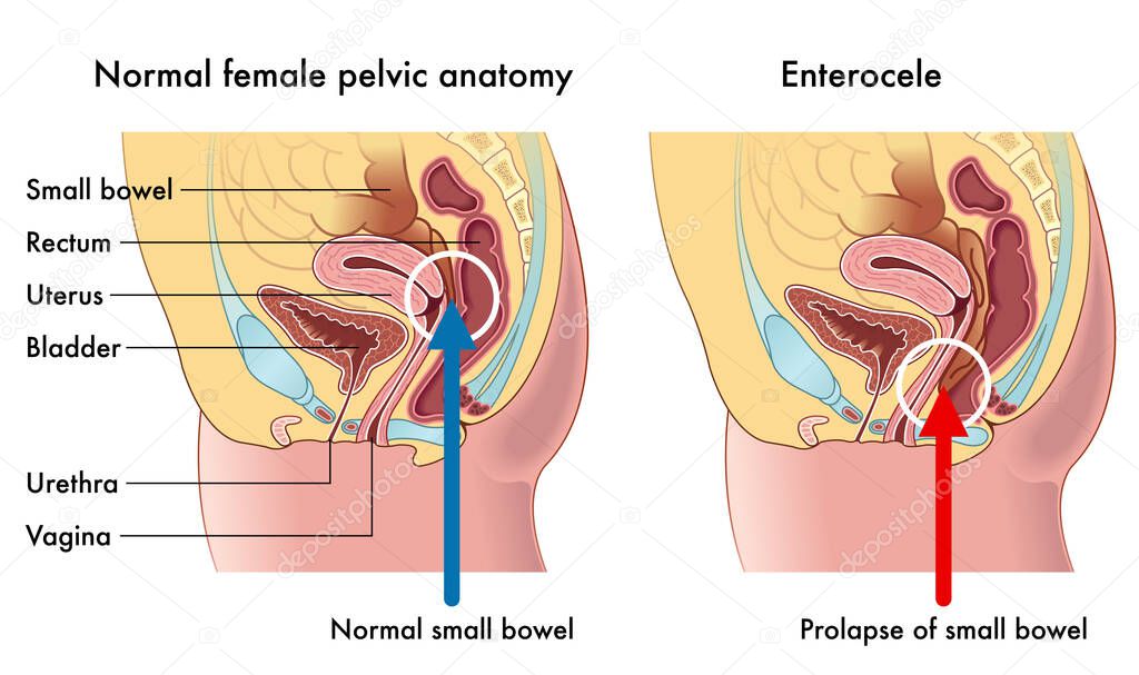 Medical illustration shows the female pelvic anatomy, one with normal small bowel, compared with one with prolapse of small bowel called Enterocele.