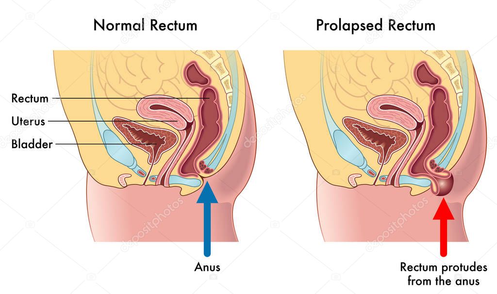 Medical illustration showing the difference between a normal rectum and a prolapsed rectum, with annotations explaining how this occurs.