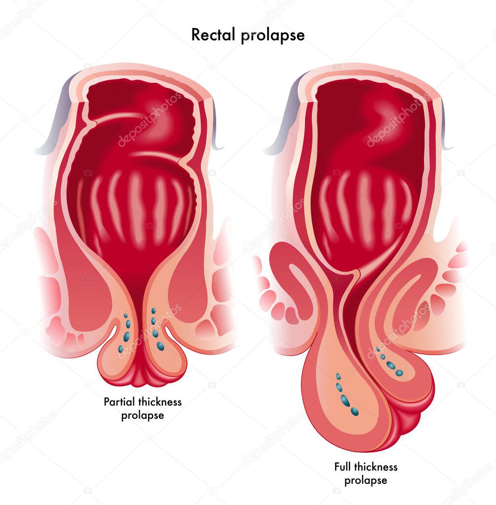 Medical illustration showing two types of rectal prolapse, a partial thickness prolapse, and a full thickness prolapsed.