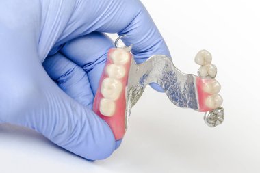 Çıkarılabilir kopça protezi diş hekiminin ellerindeki üst çenede istiridye saplantısı ile