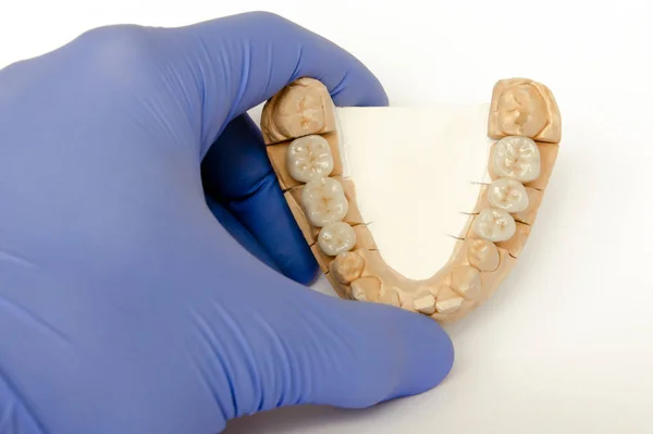 Dişçinin elindeki alçı bir modelin üzerindeki seramik metal köprüler. seramik taçlar, köprüler, implantlar