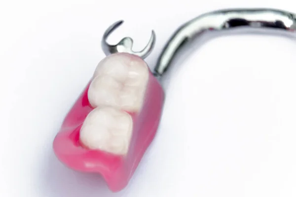 Το ήμισυ της αφαιρούμενης οδοντοστοιχίας στην κάτω γνάθο. ψευδή δόντια — Φωτογραφία Αρχείου