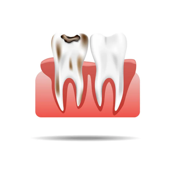 Esmalte Caries Infección Salud Diente Pulpitis Realista Estomatología Salud Ilustración — Archivo Imágenes Vectoriales