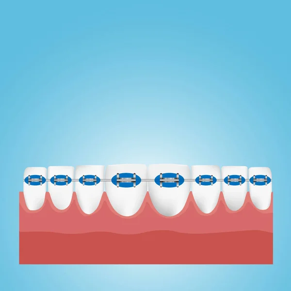 Ortodoncia Dientes Aparatos Dentales Ilustración Vectorial — Archivo Imágenes Vectoriales