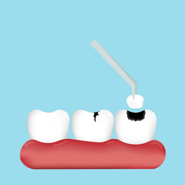 Llenado Dientes Encías Aisladas Sobre Fondo Azul Concepto Dental Ilustración — Archivo Imágenes Vectoriales