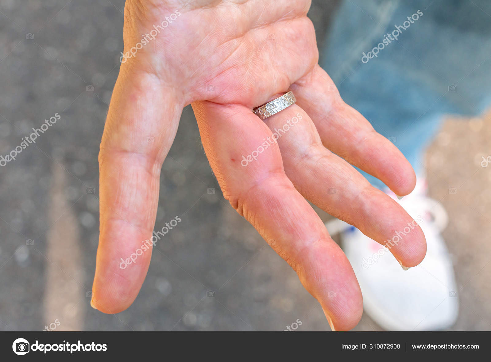 My Finger is Swollen – Am I Normal? | University of Utah Health