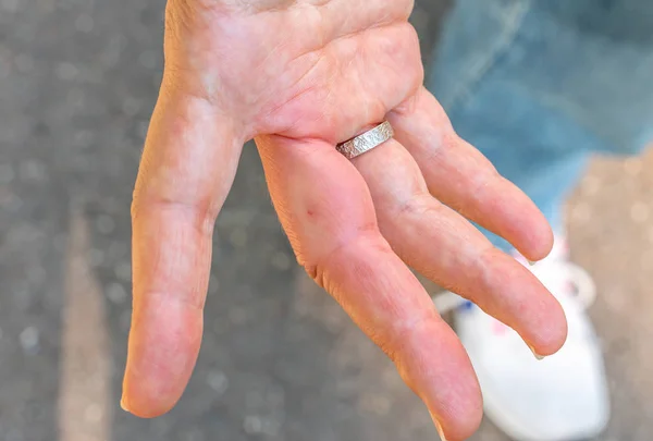 Una Mano Derecha Con Dedo Hinchado Después Una Picadura Abeja — Foto de Stock