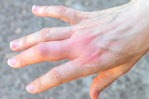 Fragmento Mano Derecha Con Dedo Medio Grande Hinchado Después Una — Foto de Stock