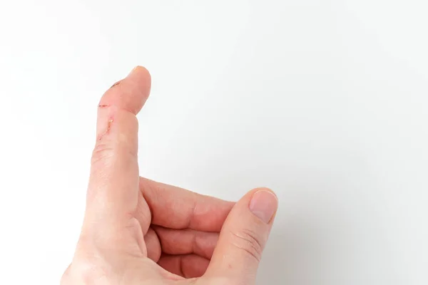 Skåret Pegefinger Med Extensor Seneskade Hammer Finger Fingerspids Bøjning Nedad - Stock-foto