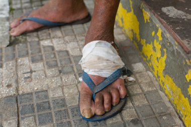 Cunha, Sao Paulo, Brezilya - 11 Ocak 2016: Bir kaldırımda, yaranın üzerine kocaman bir bandaj sarılı parmak arası terlik giyen evsiz bir adamın ayrıntıları