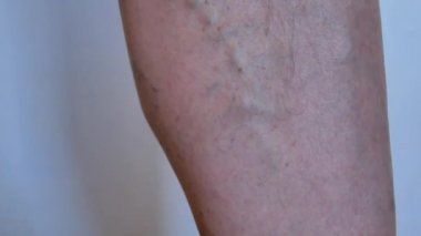 yaşlı adam ile genişlemiş, varis - teftiş yapan ayağı şişmiş, doktor ve büküm damarlar ne zaman kan akışını yanlış yönde. yakın çekim 4k video görüntüleri